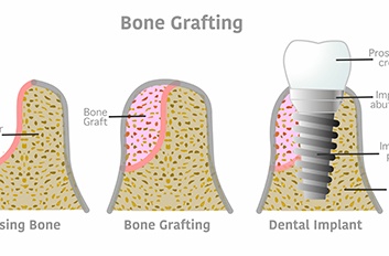 Diagram showing result of dental bone graft