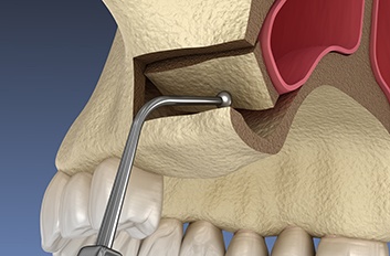 Illustration showing part of sinus lift surgery