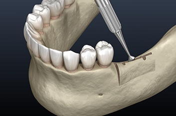 Illustration showing ridge augmentation surgery