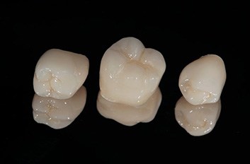 Dental crowns?