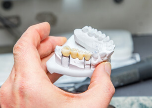 Dental bridges close the gaps between missing teeth