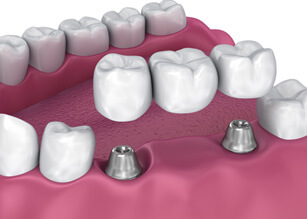 An implant bridge secures to your mouth via dental implants