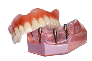 implant denture model showcased against white background