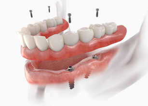 illustration of implant denture for lower arch