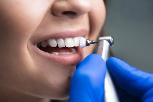 Dentist polishing a patient’s teeth