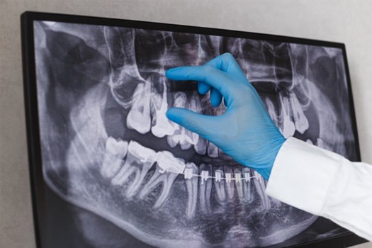 Dentist pointing to a tooth on a patient’s X-ray