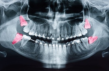 Dental X-ray showing four wisdom teeth