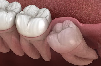 Close-up digital image of impacted wisdom tooth